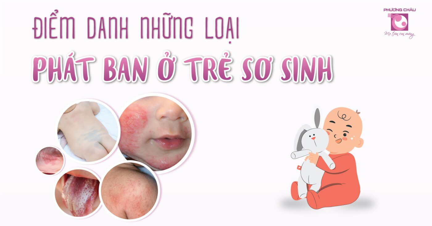 Điểm danh những loại phát ban ở trẻ sơ sinh