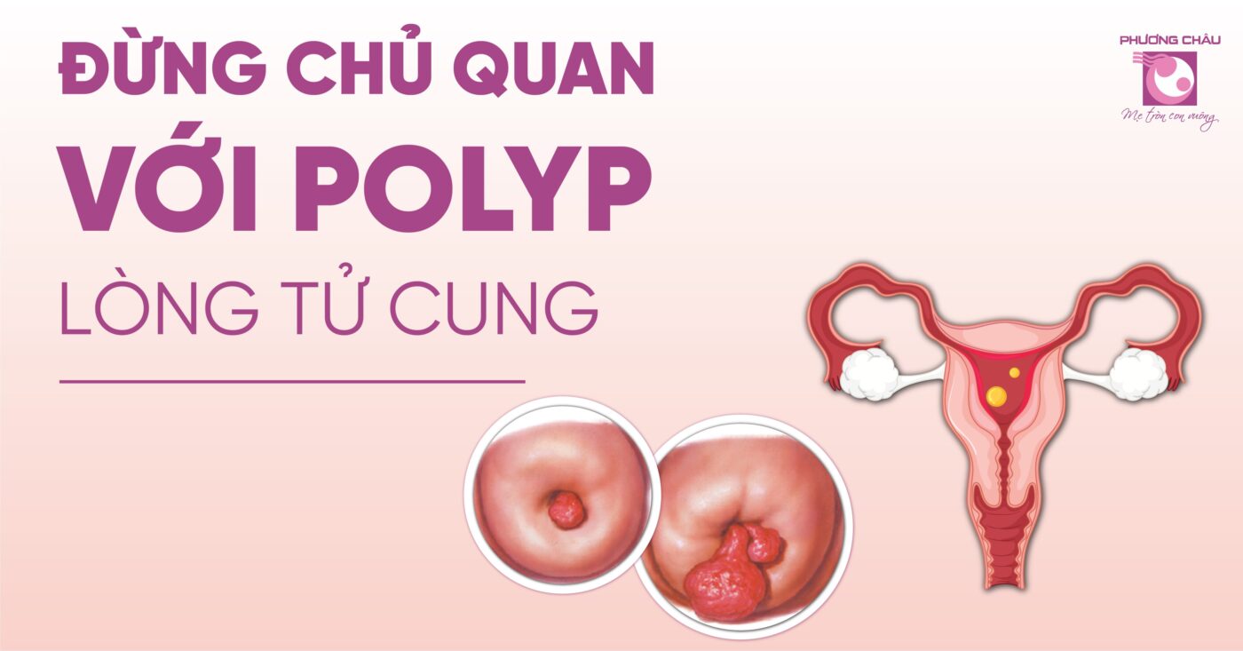 đừng chủ quan với polyp lòng tử cung